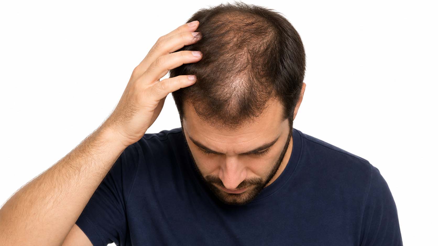 Finasteride para el cuidado capilar masculino